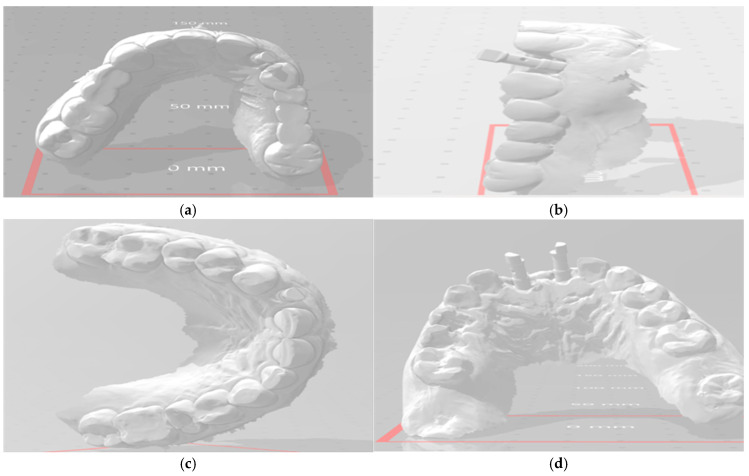 Comparative Evaluation of Customized CAD/CAM vs. Stock Titanium Abutments for Immediate Implant Placement in Class II Extraction Sockets: A Randomized Controlled Trial.