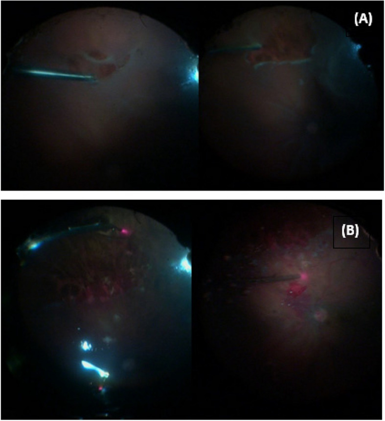 Outcomes of perfluorocarbon liquid vs. posterior retinotomy as adjuncts during pars-plana vitrectomy for the surgical repair of rhegmatogenous retinal detachment: a randomized clinical trial.