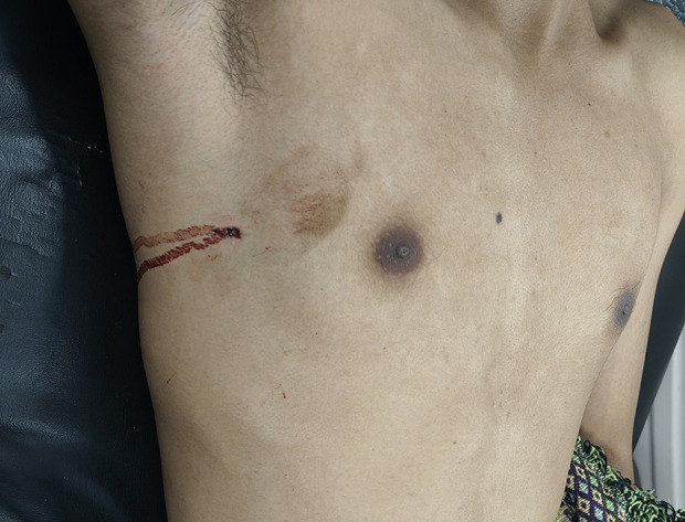 Air Rifle Injury: Rare Bullet Lodgement in the Right Ventricle and Successful Surgical Removal.