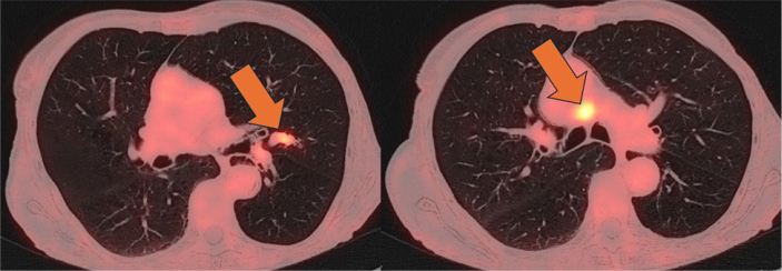 Misleading Detection of Herpes Simplex Virus Type 1 In A Patient with Paraneoplastic Encephalitis.