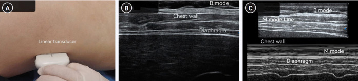 Diaphragm ultrasound for predicting weaning success in post-cardiac surgery acute respiratory distress syndrome patients: a prospective observational study in China.