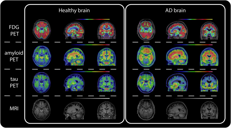 Fueling the brain - the role of apolipoprotein E in brain energy metabolism and its implications for Alzheimer's disease.