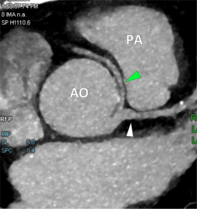Anomalous Origin of the Right Coronary Artery from the Left Main Coronary Artery in A Patient with Non-Specific Chest Pain.