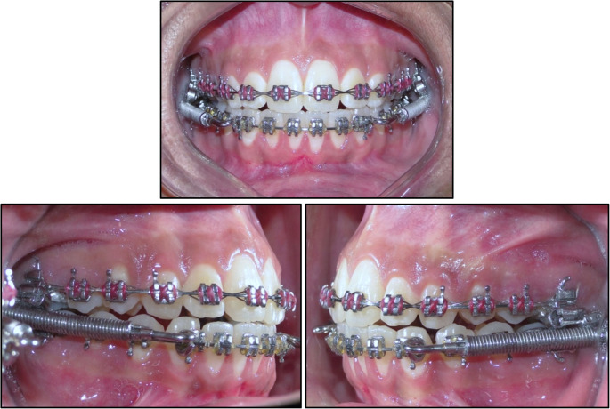 Positional and dimensional temporomandibular joint osseous changes in patients treated with the forsus fatigue resistant device: a non-randomized clinical trial.