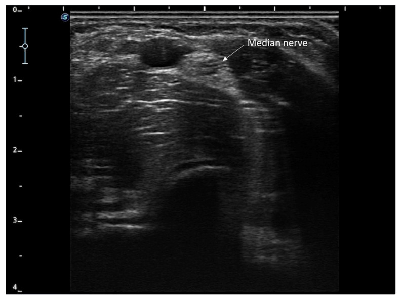 Percutaneous Peripheral Nerve Stimulation in Chemotherapy-Induced Neuropathy: A Case Report.