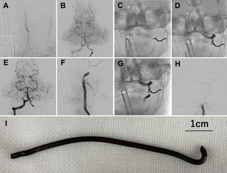 Distal and proximal embolization for penetrating vertebral artery injury: illustrative case.