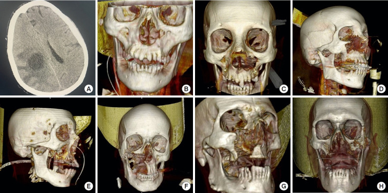Midface defects caused by mucormycosis with a new classification: a retrospective study.