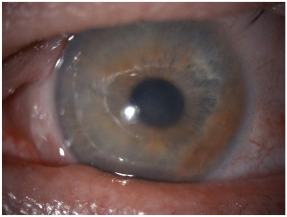 Descemet's membrane endothelial keratoplasty in an eye with iridocorneal endothelial syndrome and rare association of corneal ectasia.