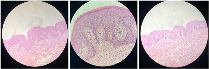 Challenges in diagnosing confluent and reticulated papillomatosis: a case of atypical lesions distribution.