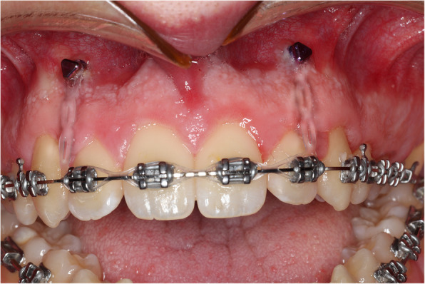 A novel technique to improve postoperative stability of orthognathic surgical anterior open bite correction using temporary anchorage devices: a case report.