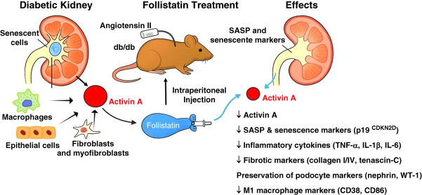 Inhibition of Activin A Signaling by Follistatin Alleviates Diabetic Kidney Disease Burden.