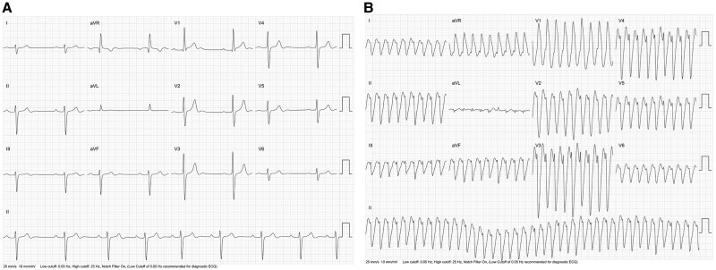 Clockwise bundle branch re-entrant ventricular tachycardia in a teenage patient as the first manifestation of dilated cardiomyopathy associated with the p.Ile512Leu TNNI3k variant: a case report.
