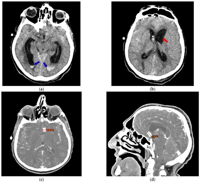 Comparing Antemortem CT-Angiography Data with Autopsy Findings in Regard to Anterior Communicating Artery Aneurysms.