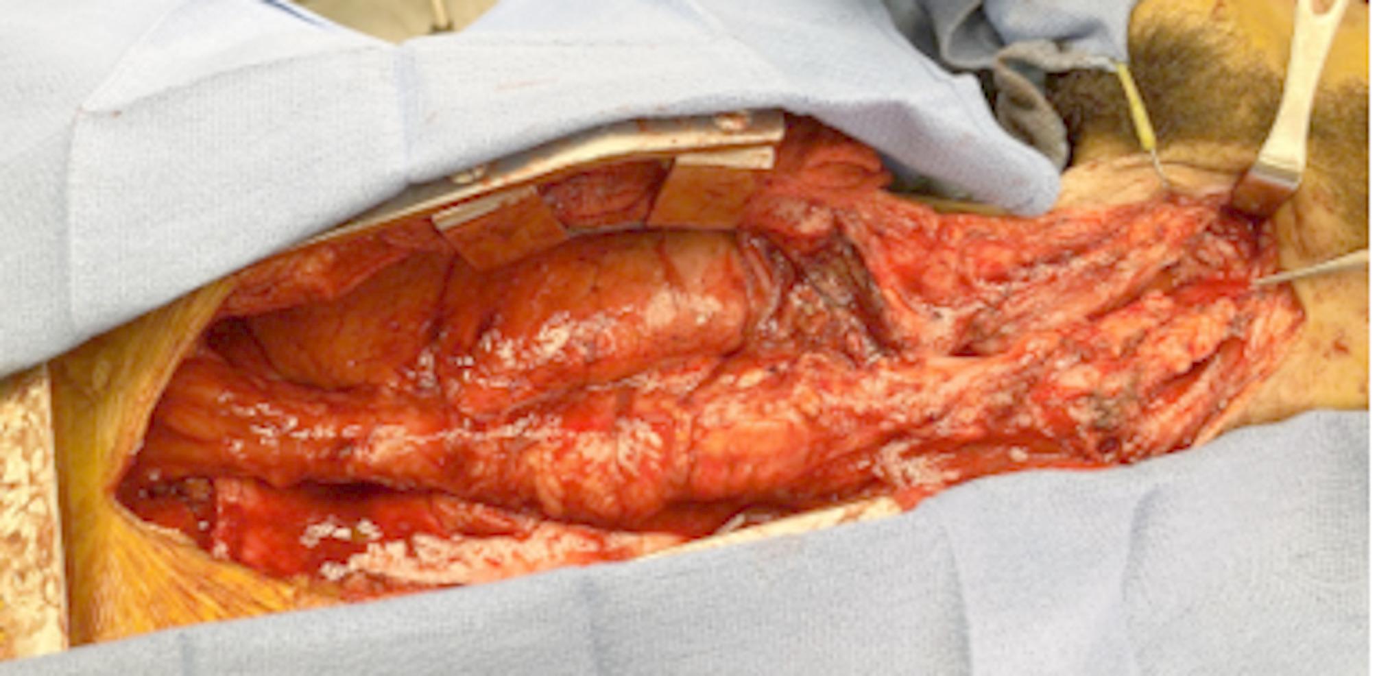 Esophageal reconstruction using a hypopharyngeal anastomosis - a single center experience with review of the literature.