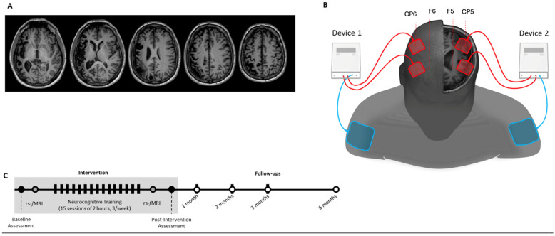 Personalized Language Training and Bi-Hemispheric tDCS Improve Language Connectivity in Chronic Aphasia: A fMRI Case Study.