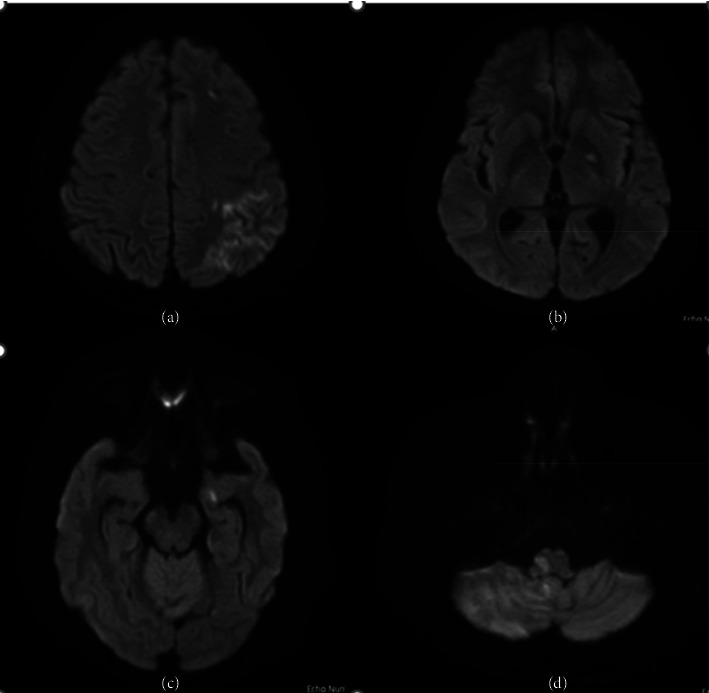 Corrigendum to "Cardioembolic Stroke Due to Prosthetic Valve Endocarditis Caused by <i>Candida parapsilosis</i>: A Case Report".
