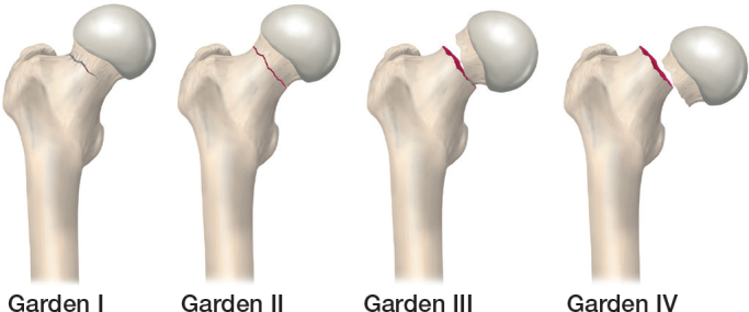 An Acta Orthopaedica educational article: Femoral neck fractures in adults with emphasis on surgical treatment.