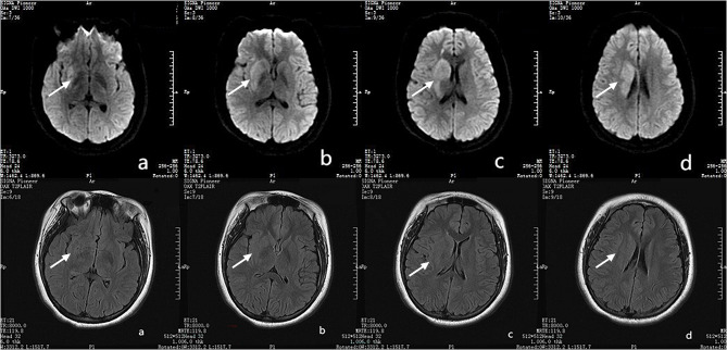 Intravenous tenecteplase thrombolysis and endovascular bridging intra-arterial tirofiban injection therapy in a pediatric case of acute ischemic stroke.
