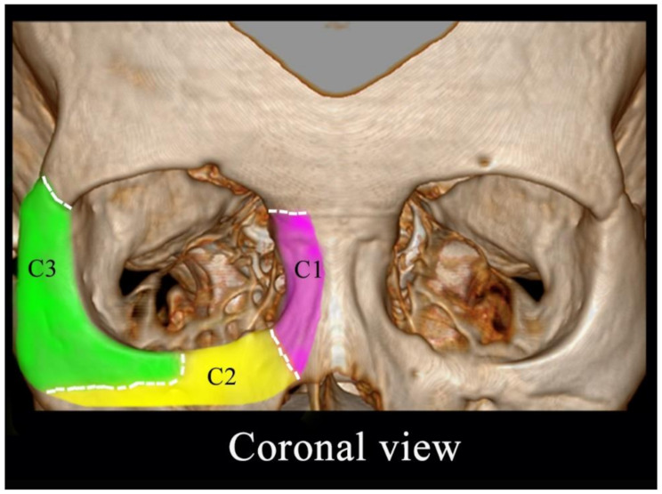 Predictors of diplopia following orbital fractures based on anatomical location, a retrospective cohort study.
