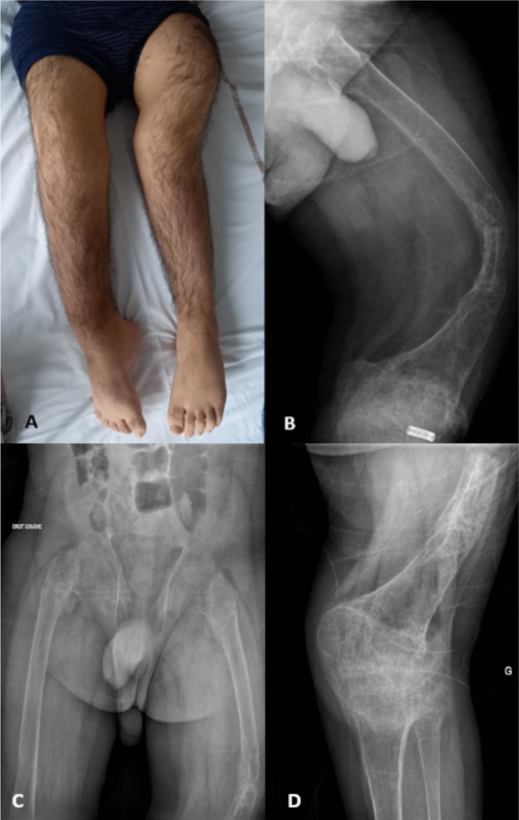 Oncogenic rickets diagnosed at age 8 and the risk of persistent rickets: a rare case of pediatric-onset tumor-induced osteomalacia.