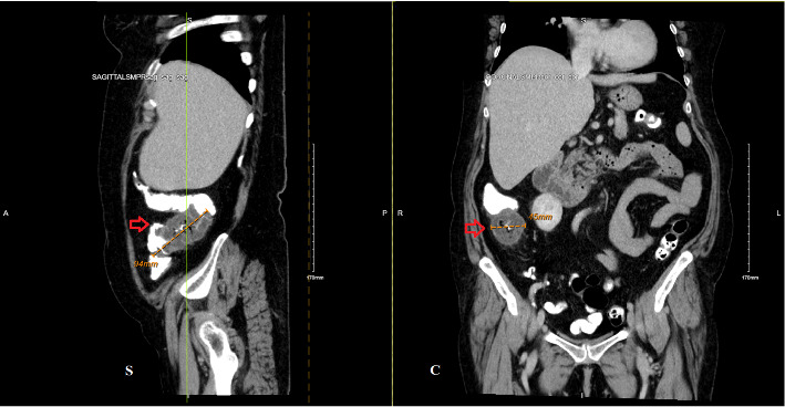 Nonsteroidal Anti-Inflammatory Drug-Induced Granulomatous Colitis: A Case Report and Literature Review of a Vanishing Colonic Mass Mimicking Malignancy.
