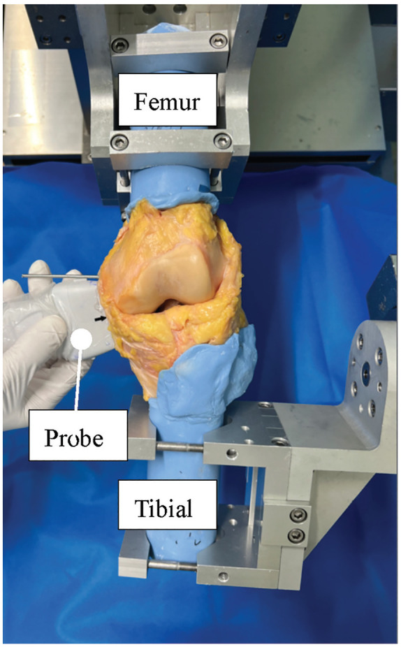 Inside-Out Repair Technique Results in Less Medial Meniscal Extrusion Than All-Inside Repair Technique for Complete Radial Tears of the Medial Meniscus Posterior Segment: A Cadaveric Study.