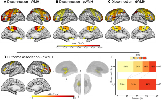 Localized network damage related to white matter hyperintensities is linked to worse outcome after severe stroke.