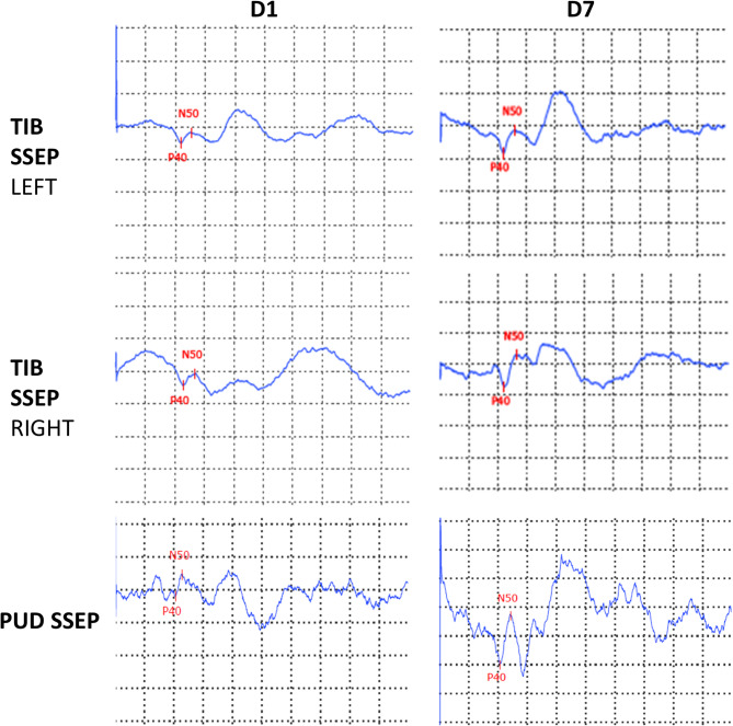 Conus medullaris and cauda equina syndrome as complications of non-imaging guided epidural steroid injection: two case reports with comprehensive interdisciplinary work-up.