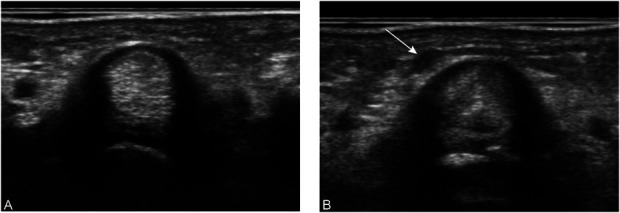 Ganglion Formation After Steroid Injection for Stenosing Flexor Tenosynovitis.