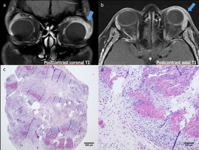 Orbital Presentation of Eosinophilic Granulomatosis with Polyangiitis: An Interventional Case Report and Literature Review.