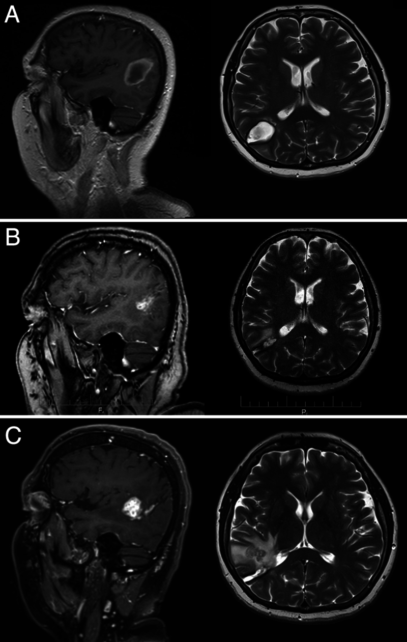 First report of adult Taenia solium in human brain with neurocysticercosis: illustrative case.