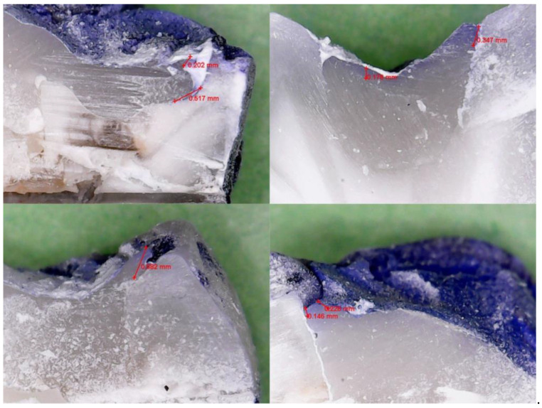 Comparative in Vitro Evaluation of Marginal Sealing in Class I Composite Restorations Using Fifth- and Seventh-Generation Adhesives.