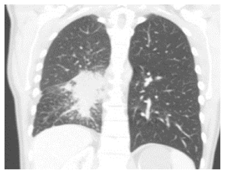 Unilateral cystic and bullous lung changes in a patient treated with brigatinib: a case report.