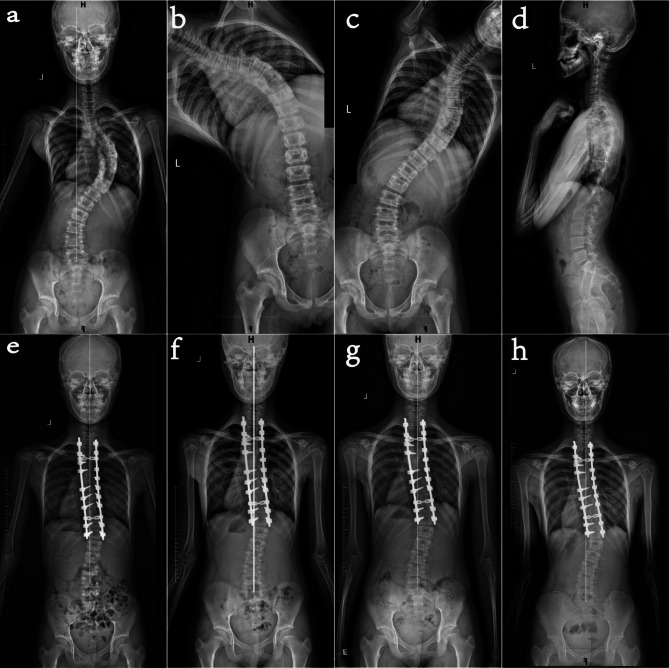 Risk factors for the progression of distal adding-on phenomenon after surgery in patients with Lenke type 1 and 2 adolescent idiopathic scoliosis.