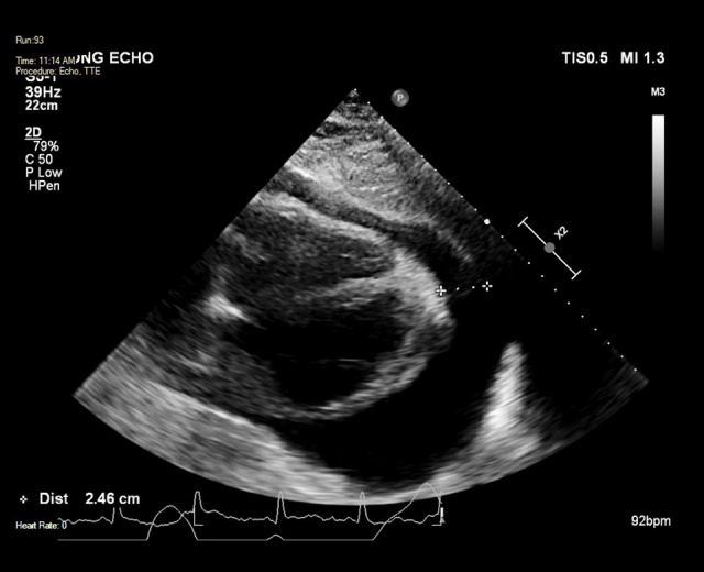 Management of Cardiac Tamponade During Systemic Lupus Erythematosus Flare with Significant Pericardial Effusion: A Case Report.