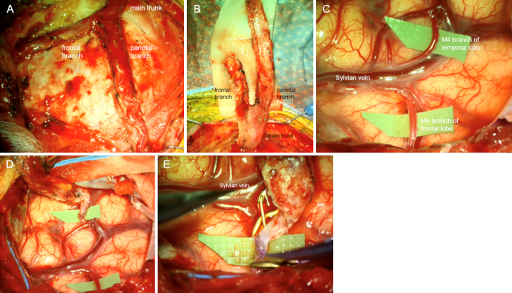 Cranial bypass for occlusive carotid dissection in osteogenesis imperfecta: illustrative case.