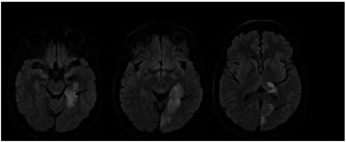 Case Report: Ischemic stroke in a young transgender woman due to unsupervised estrogen therapy.