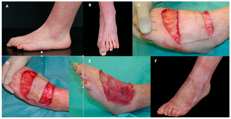 Use of Integra<sup>®</sup> Dermal Regeneration Template Bilayer in Burn Reconstruction: Narrative Review, Expert Opinion, Tips and Tricks.
