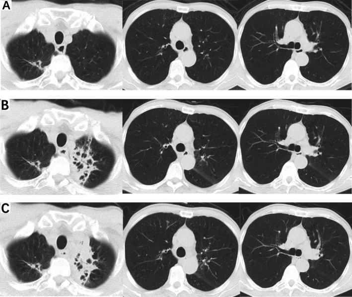 Lenvatinib-Associated Non-Tuberculous Mycobacterial Pulmonary Disease: A Case Report.