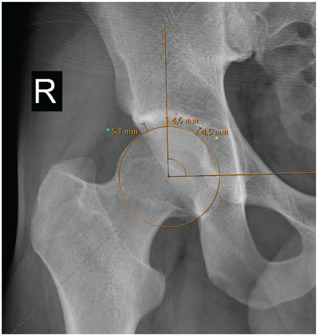 The Preoperative Central Joint Space Holds Greater Clinical Significance in Patients Aged 35 and Older Undergoing Primary Hip Arthroscopy.