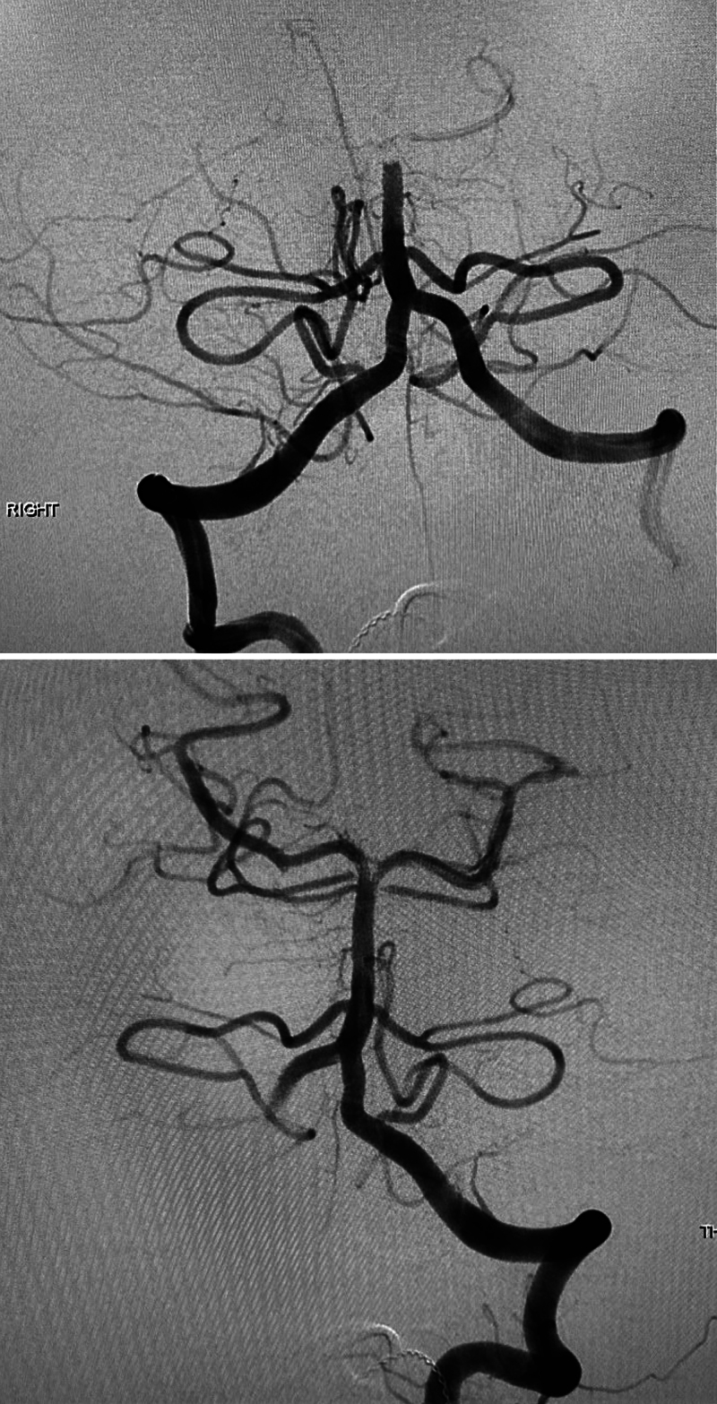 Recurrent basilar artery thrombectomy for pediatric vertebral dissection: illustrative case.