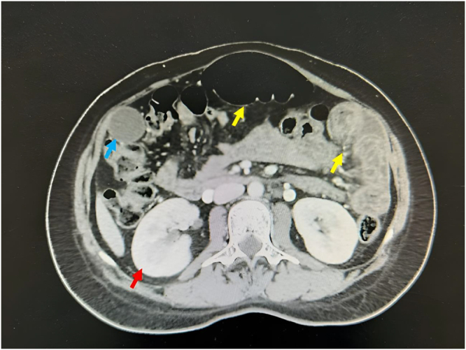 The first case report of chylous ascites in a twin pregnancy following <i>in vitro</i> fertilization: a case report of chylous ascites in twin pregnancy.