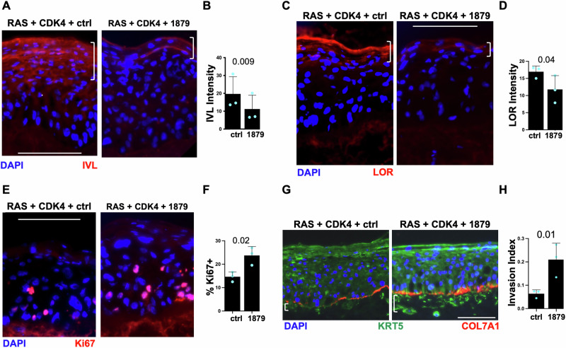A dominant SRCAP truncating mutation promotes squamous cell carcinoma progression.
