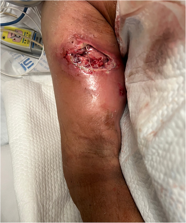Promoting early detection of necrotizing soft tissue infection of the upper extremity in patients with history of breast cancer: a case report.