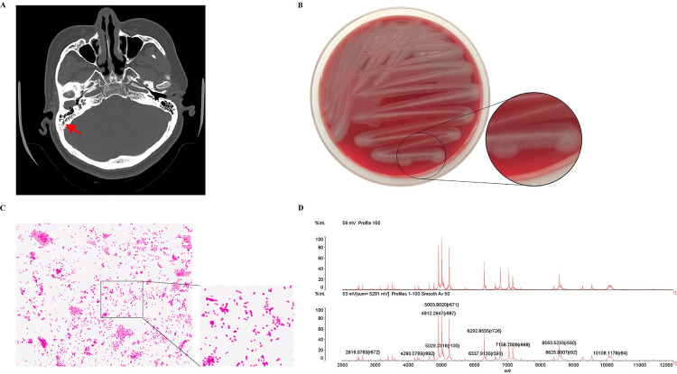 Kerstersia gyiorum infection in a patient with chronic suppurative otitis media identified by whole genome sequencing: a case report.