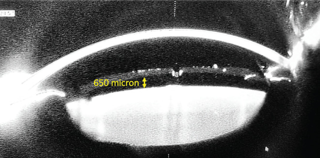 Urrets-Zavalia Syndrome After Posterior Chamber Phakic Intraocular Lens Implantation: An Unusual Complication.