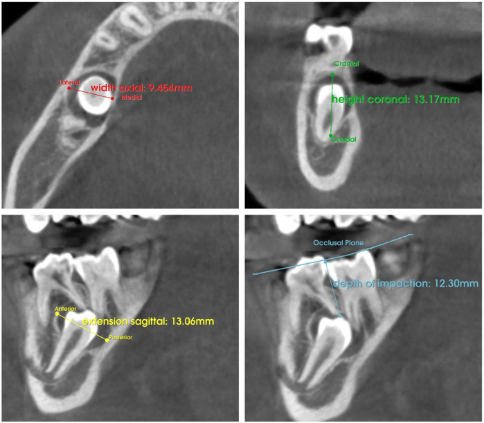 Influence of odontogenic lesions on root development in impacted teeth: a cohort study.