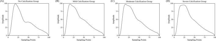 Pulse wave-driven machine learning for the non-invasive assessment of coronary artery calcification in patients with end-stage renal disease undergoing hemodialysis.