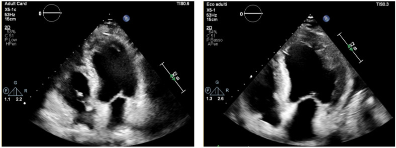 Multimodality Imaging in Eosinophilic Myocarditis: A Rare Cause of Heart Failure.