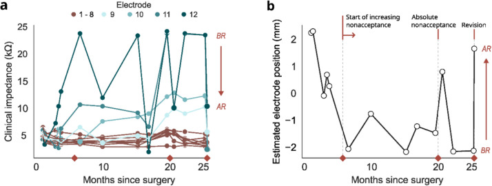 Impedance-based detection of cochlear implant array migration: case report in a child with Aymé-Gripp syndrome.